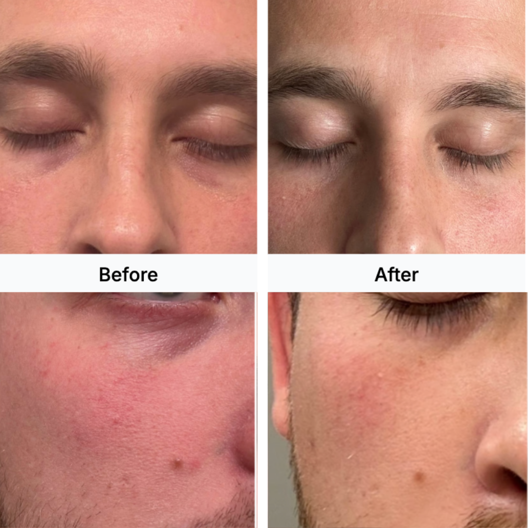 Before and after comparison of a man's face with visible skin improvement.