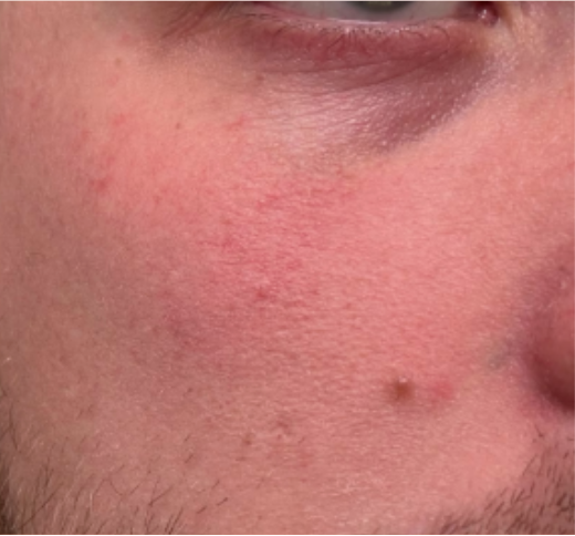 Before and after comparison of a man's face with visible skin improvement.