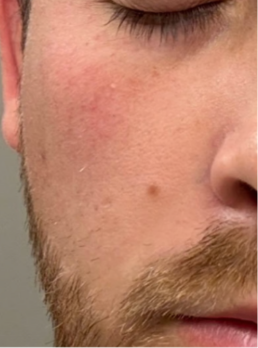 Before and after comparison of a person's face with acne, showing the product's effectiveness.