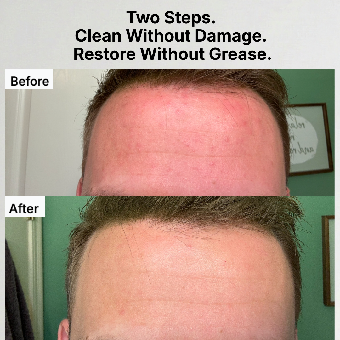 Before and after comparison of a person's forehead with text 'Two Steps. Clean Without Damage. Restore Without Grease.'